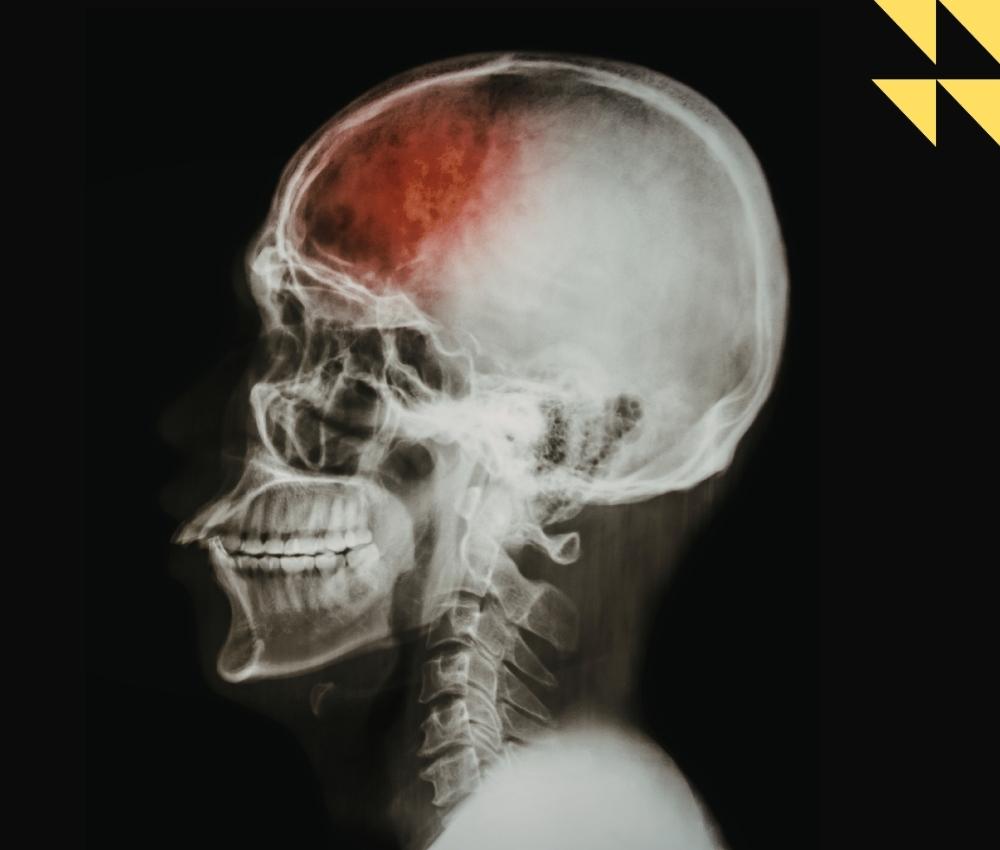 Houston Brain Injury Attorney