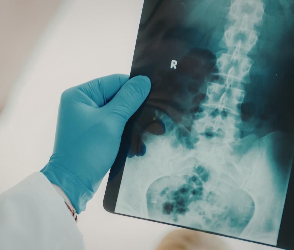 Houston Spinal Cord Injury Attorney