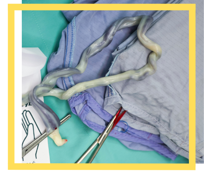 Umbilical Cord Prolapse Injury Attorney in Houston, TX