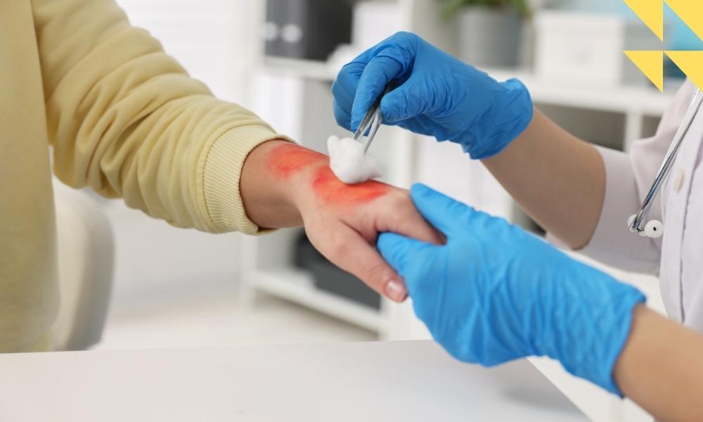 Burn Injury Lawyer Houston, TX