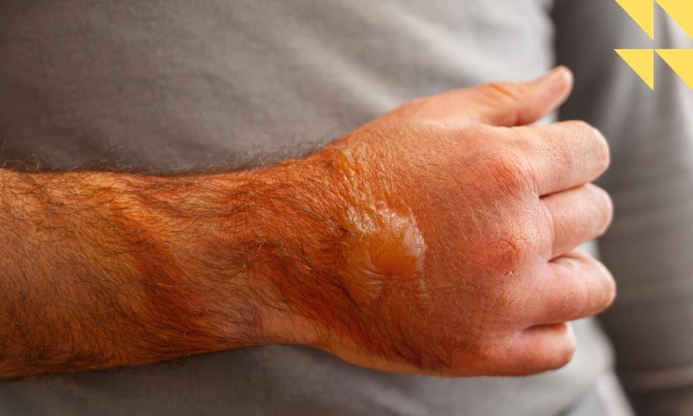 Houston Burn Injury Law Firm