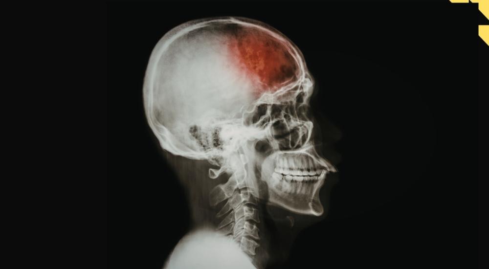 Houston Brain Injury Attorney