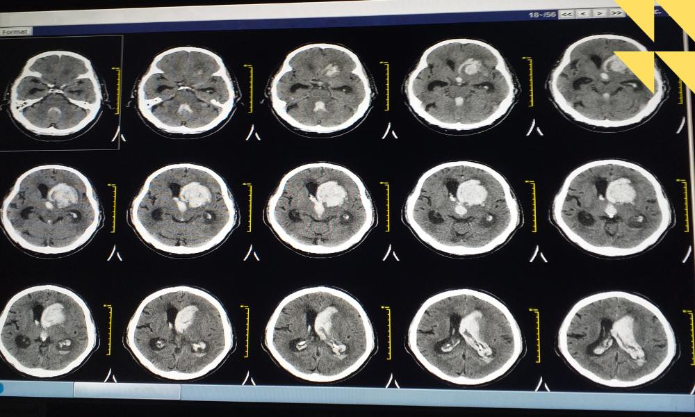 Houston Intracranial Hemorrhage Birth Injury Attorney