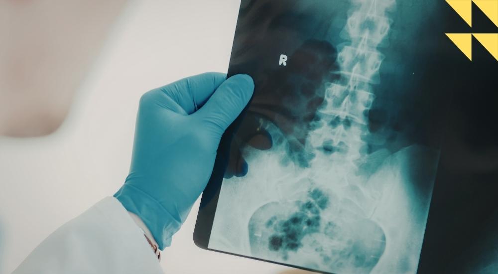 Houston Spinal Cord Injury Attorney