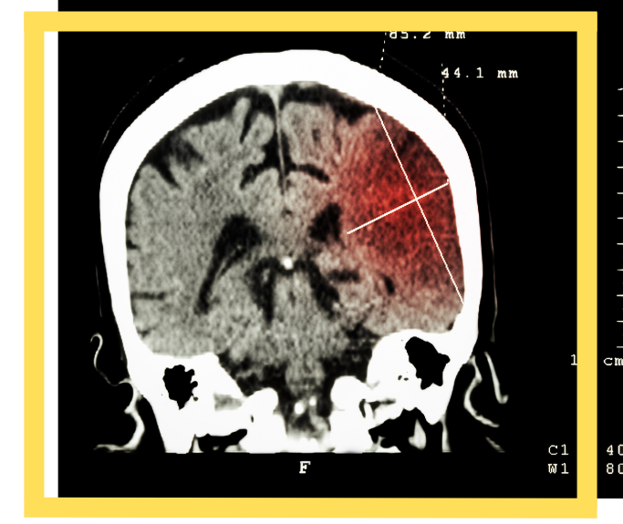 Houston, Texas Stroke Misdiagnosis Attorney